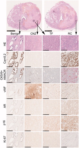 Figure 4. Immunohistochemical staining patterns of different prostatic regions after thermal injury. Two parallel HE-stained macro-sections from mid-prostate are shown from the same patient. High magnification images from benign-untreated region, coagulative necrosis zone (CNZ), thermally-fixed region (TF) and residual carcinoma (RC) with different stainings are shown below, and the defined regions are indicated with squares in the low magnification macro images. Note that there is a loss of cytokeratin 8 (Cam5.2) and AMACR staining in both CNZ and TF regions. A strong extracellular staining for vWF is seen in CNZ, while the staining is restricted to vessels in other regions. AR and p16 are weakly positive in CNZ and TF regions but virtually more abundant in RC region. Scale bar 10 mm for macro-sections, 0.5 mm for high magnification images.