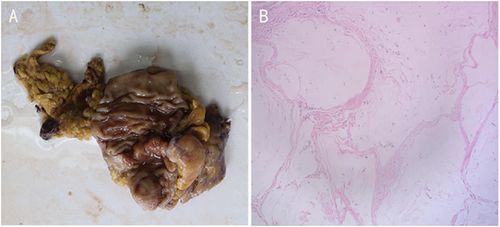 Figure 3 Specimen examination showed a 4cm×1.5cm bulged mass located ileocecal valve with hard gray texture on section (A). Histological analysis of the specimen and resected 14 lymph nodes revealed no malignancy (B).