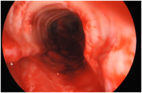 Figure 1. Endoscopic view of a level IIA-tracheal rupture following balloon dilatation of a tracheal stenosis.