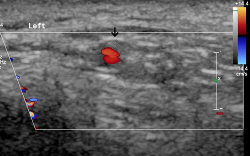 Figure 3 Cross-sectional Doppler ultrasound view of the left temporal artery in a 72-year-old patient with giant cell arteritis. The arrow shows the hypoechogenic halo sign.