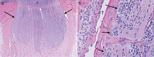 Figure 2. Histology slides showing an enlarged distal optic nerve with tumor cells (purple) occupying the entire width of the optic nerve (black arrows in a) corresponding with findings on MRI. Notice the lamina cribrosa bulging outwards (white arrow in a), probably from a high-ocular pressure (44 mmHg), and possibly partly due to mass effect from the intraocular tumor (§ in a). The tumor cells (black arrows in b) reach the outer layers of the optic nerve all the way up to the pia mater (* in b) with the CSF space represented by the void adjacent to the pia († in b).