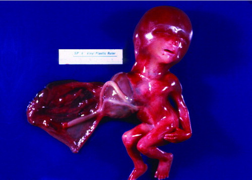 Figure 3.  Gross photograph of Patient 2 showing fetus with a right antero-lateral body wall thoracoabdominoschisis covered by amnion. The right upper extremity is missing, the umbilical cord is short and the lower extremities are slightly contracted.