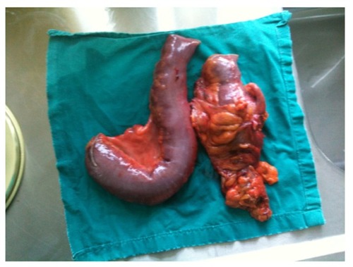 Figure 1 CA Sigmoid and synchronous cancer in transverse colon.