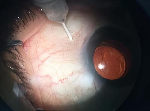 Figure 2 Injection of TA in the suprachoroidal space using a custom-made syringe.