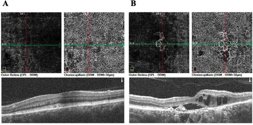 Figure 8. OCT angiography revealed the development of choroidal neovascular membrane (CNVM) in the left eye. A: Right eye: mild non-perfusion in the superficial vascular complex and deep capillary complex, no CNVM. B. Left eye: moderate non-perfusion in the deep capillary complex with CNVM.