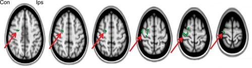 Figure 8 Difference between scans (First > Second scan) of lip pursing > rest averaged across completed patients, showing a decrease (reversal) of the shift into the hand representation of the cerebral cortex with the lip pursing task (in green, arrowed). Images flipped so that left is contralateral to the amputation and right is ipsilateral (FSL with fixed effects, cluster corrected for multiple comparisons p<0.05).