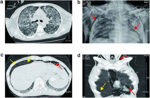 Figure 3. (a) Chest CT scan revealed bilateral diffuse infiltration indicated pulmonary hemorrhage of Patient 3; (b) chest plain radiograph showed pneumomediastinum and subcutaneous emphysema of Patient 5 (red arrow). (c) and (d) Chest CT scan showed pneumomediastinum, subcutaneous emphysema (red arrow) and parenchymal tears of Patient 7 (yellow arrow)