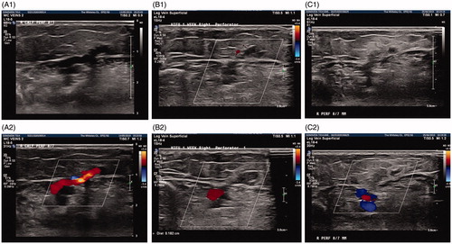 Figure 4. Grey scale (A1, B1 and C1) and colour flow ultrasound images (A2, B2 and C2) of an incompetent perforating vein: (A) before treatment, (B) 1 week after treatment, and (C) 6 weeks after treatment with Sonovein (HIFU).