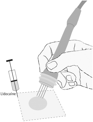 Figure 5. Carrying out treatment. Electrochemotherapy is performed under analgesia; for smaller tumours local anaesthesia (as indicated here) whereas larger tumor conglomerates necessitate general anaesthesia. The chemotherapeutic agent, bleomycin, is either injected locally (few, small tumours), or systemically for large and/or many tumours. After drug administration the electric pulses are administered through the electrodes that are inserted into the tumour tissue. The electrodes are systematically moved, and pulses applied again, in order to cover the entire tumour area. The pulsing sequence is very brief, and therefore even large tumours may be covered in the course of a single treatment because the procedure proceeds quickly.