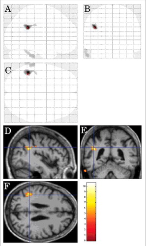 FIGURE 4. Inter-CJD SPM analysis (using a stringent level of significance of p<0.001 and an extent threshold of 100 voxels), in CJD patients with myoclonus, showing hypometabolism in the left lateral parietal cortex.