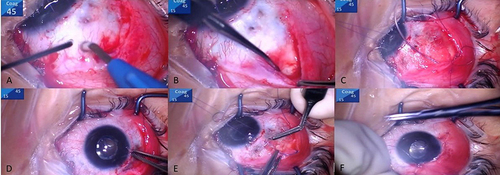 Figure 1 Surgical steps of Paul glaucoma implant (PGI) insertion. (A) Fornix-based peritomy was performed, and bleeding points were cauterized, (B) The rectus muscles were isolated, (C) The PGI was inserted (note the ripcord inside the tube lumen), (D) Holding the tube end before inserting it into the anterior chamber, (E) The tube is secured underneath a scleral flap, (F) The conjunctiva was closed.