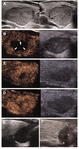 Figure 3. The conventional US and CEUS images of a 41-year-old male in the V group during each ablation (A) A solid nodule located in the right thyroid before treatment with an initial volume of 6.07 ml. (B) At 1 month after the first RFA, the total volume was 2.61 ml and VRR was 57.00%. CEUS showed residual vital tissues located in the peripherally area (arrow). The vital volume was 2.09 ml. (C) At 3 months after the first RFA, the total volume was 1.21 ml and VRR was 80.07%. CEUS showed the vital volume 1.12 ml. (D) At 6 months after the first RFA, the total volume enlarged to 1.79 ml and VRR was 70.51%. Vital volume increase was found in CEUS, which was 1.78 ml. Additional RFA was performed. (E) At 3 months after additional RFA, the total volume was 0.67 ml and VRR was 88.96%. (F) At 6 months after additional RFA, the total volume decreased to 0.11 ml and VRR was 98.19%.