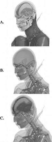 Fig. 5. Head displacement at 75 ms in frontal sled impact simulation (Shaw et al. Citation2009) showing modular brain addition. (A) M50-O with maximum principal strain fields, (B) standard M50-OS, and (C) M50-OS with detailed brain from M50-O.