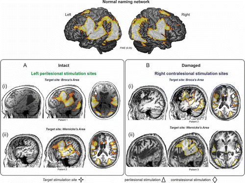 Figure 2. Illustration of potential target sites of stimulation to facilitate naming performance in relation to structural brain damage and the normal naming network in three different patients. The top panel illustrates the extensive bilateral fronto-temporal naming network found in an fMRI study of healthy older particpants (cf. Holland et al., Citation2011). Activation is overlaid onto a rendered cortical surface from SPM8. In the lower panels of the figure we overlay the normal pattern of brain activation onto three chronic aphasic stroke patients' individual structural MRI scans. The aim here is to illustrate from left to right for each patient: (1) their structural brain damage within the left hemisphere, (2) the normal naming network overlaid onto their individual brain scan to show the relationship between the lesion damage to the naming network and the target stimulation site (red cross), and (3) the stimulation sites feasible for each patient depending on the proposed target site. Panel A highlights, in two chronic aphasic stroke patients, that structurally intact regions of cortex within the lesioned left hemisphere may serve as potential candidate sites for anodal stimulation to facilitate treatment of anomia in (Ai) Broca's area and (Aii) Wernicke's area. Panel B highlights that when the lesion is has damaged relevant cortices in the left hemisphere perilesional stimulation may not be possible. Therefore, for the two patients illustrated, facilitation of the contralesional hemisphere may be the optimal approach to aid recovery: (Bi) right homologue to Broca's area and (Bii) Wernicke's area. Although not illustrated here, in cases where patients have suffered a large MCA infarct affecting the whole of the left hemisphere and resulted in extremely limited perilesional tissue, stimulation of the contralesional hemisphere would be the sole option. Furthermore, studies of aphasia recovery have successfully used anodal stimulation of the left perilesional hemisphere to elicit positive behavioural outcomes, however the effects of anodal or cathodal stimulation of the right contralesional hemisphere are, as yet unknown, and will be dependent on the theoretical hypotheses of the research. To view this figure in colour, please see the online issue of the Journal.