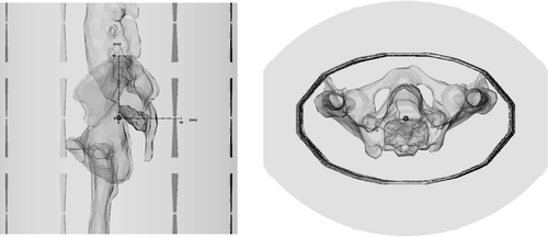 Figure 1. Model of the phantom used for this calculation study in sagittal and transverse direction. The central point (0, 0, 0) is marked as little orange spot and the axes in the sagittal picture show the distances in cm. The x-axis goes right–left, with positive values on left (L). The y-axis is anterior–posterior with positive values posterior (P) and the z-axis goes caudal-cranial with positive values cranial or head (H), building a L-P-H system. The presacral tumor is shown in red, located posterior from the centre of the model with its centre of gravity about 2 cm posterior to the centre of the model. Calculated fatty tissue is a small equidistant border around the elliptic phantom material. Phantom material is calculated as muscle tissue.