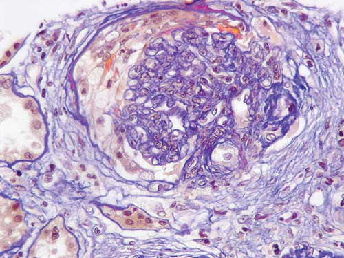 Figure 2.  Renal biopsy on day 4 showing necrotizing crescentic pauci-immune glomerulonephritis (acid fuchsin-Orange G staining).