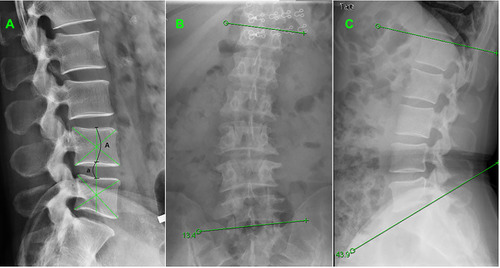 Figure 5 Radiographic measurement of DHI, Cobb angle and LL. (A), Mid-vertebral line (the line passing through the intersection of 2 diagonals of L4 and L5) was used to measure the heights of vertebral body and disc. DHI = a/A. (B), Cobb angle was defined as the crossing angle between the extension line of the upper and inferior edge of the apex vertebrae. (C), LL was the angle between the extension line of the upper edge of L1 and the extension line of the upper endplate of S1.