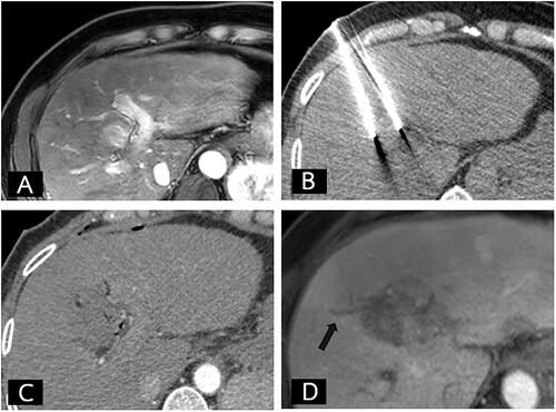 Figure 2. Pre-operative, intra-operative, and post-operative imaging of IRE group. (A) Fifty-one-year-old man with a small hepatocellular carcinoma at liver segment IV. (A) The arterial phase MRI of liver showed a 25-mm arterial enhancing nodule less than 5 mm from the bile duct. (B) The axial non-contrast enhanced CT during the IRE procedure revealed the proper position of the two IRE electrodes. (C) The immediate post-operative contrast-enhanced CT showing the ablated area of the tumor. (D) A 1-month follow-up MRI revealed complete IRE ablation without residual tumor but with adjacent focal bile duct dilatation (arrow).