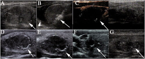 Figure 2. Sonograms of a 36-year-old male with T2 papillary thyroid carcinoma. (A) A hypoechoic nodule with an initial volume of 11.39 ml was detected in the right thyroid lobe (white arrow). (B) The nodule was covered by a hyperechoic area (white arrow) during the radiofrequency ablation (RFA) procedure, and hydrodissection (arrow head) was used to protect the vital organs from thermal injury. (C) Immediately after RFA, the ablated zone showed non-enhancement on contrast-enhanced ultrasonography. (D–G) The volume of the ablated zone was 4.91 ml, 3.76 ml, 2.40 ml and 1.81 ml, respectively, at 1, 3, 6 and 27 months after RFA.