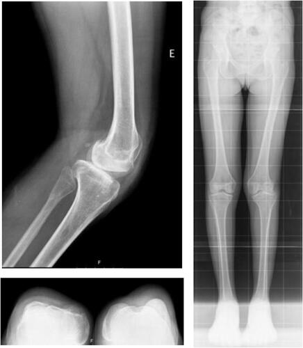 Figure 1 Pre-operatory X-rays; long-leg (left), side view (top right), axial view (bottom right).
