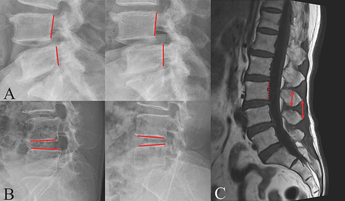 Figure 1 Functional lateral radiographs and magnetic resonance imaging. (A and B). Translation greater than 3 mm or changes in angulation greater than 9° subtended between solid lines on the lateral flexion and extension standing radiographs were considered to show segmental instability. C. To measure the height of the spinous process (anterior arrow), a line parallel to the posterior wall of the vertebral body (dotted line) was drawn first and the maximum length among all the slice lengths was obtained. Inter-spinous process distance (posterior arrow) was defined as the distance between midpoints of the spinous processes.