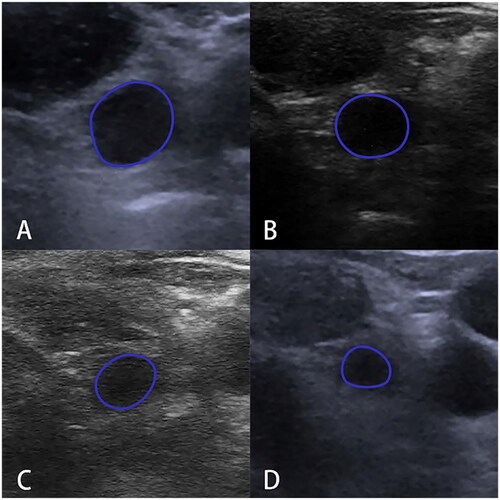 Figure 4. Ultrasonogram of left cervical non-metastatic lymph node at VI level in a patient after PTC thermal ablation. A. Lymph node volume was 0.23 ml at the 1st month after ablation; B. Lymph node volume was 0.14 ml at the 3rd month after ablation; C. Lymph node volume was 0.06 ml at the 6th month after ablation; D. Lymph node volume was 0.05 ml at the 12th month after ablation. A gradual decrease is observed.