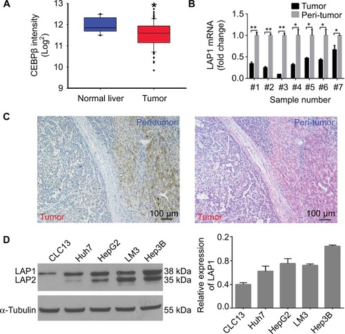 Figure 1 LAP1 is weakly expressed in HCC.Notes: (A) CEBPβ was weakly expressed in patients with HCC. CEBPβ expression in HCC tumor and normal liver tissues provided by Park’s cohort (GSE62232) was analyzed. (B) LAP1 expression levels were verified in samples of patients with HCC by qRT-PCR. GAPDH served as a loading control. (C) HCC samples were assayed by immunohistochemical and H&E staining. Scale bar: 100 µm. (D) The endogenous levels of liver-enriched activating protein and liver-enriched inhibitory protein were determined by Western blot using rabbit IgG anti-CEBPβ (sc-150) and horseradish peroxidase-labeled anti-rabbit IgGs. The α-tubulin protein level was used as a loading control (left panel). For each cell, three independent protein samples were analyzed, and each band was quantified and LAP1 protein expression was normalized with the expression level of the α-tubulin gene. Mean ± SD are represented (right panel). Student’s t-test was used for statistical analysis, *P<0.05 and **P<0.01; data are shown as mean ± SD. Data are representative of at least three independent experiments.Abbreviations: CEBPβ, CCAAT/enhancer binding protein beta; HCC, hepatocellular carcinoma; IgG, immunoglobulin G; LAP1, liver-enriched activator protein 1; qRT-PCR, quantitative real time polymerase chain reaction.