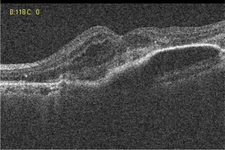 Figure 1 Case 2: Pre-ranibizumab therapy: Cirrus OCT macular cube (512 × 128) showing intra-retinal fluid.