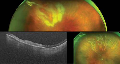Figure 4. Toxoplasma retinochoroiditis in an immunocompromised patient. Ultra-widefield pseudocolor shows active patches of retinochoroiditis, which appears hyperreflective on optical coherence tomography. The presence of toxoplasma was confirmed by polymerase chain reaction (PCR) on an aqueous tap. The image in the bottom right shows the healed retinochoroiditis.