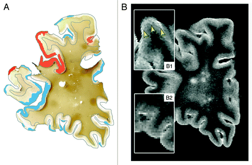 Figure 2. Post-mortem MRI and accompanying PLP immunohistochemical staining of a coronal section. T2 weighted MRI scans (B) were compared with PLP stainings (A) of the same coronal sections. This figure clearly shows the difficulty to detect cortical lesions with conventional MRI sequences. (A): MRI-visible cortical lesions are shown in red, while MRI-invisible cortical lesions are shown in blue (original magnification 0.7x); (B1): MRI-visible lesions are indicated with arrowheads. MRI-visible cortical lesions show only very subtle increase of signal intensity; (B2) MRI-invisible lesions. Reproduced from Seewann et al.,Citation25 with permission from SAGE Publishers.