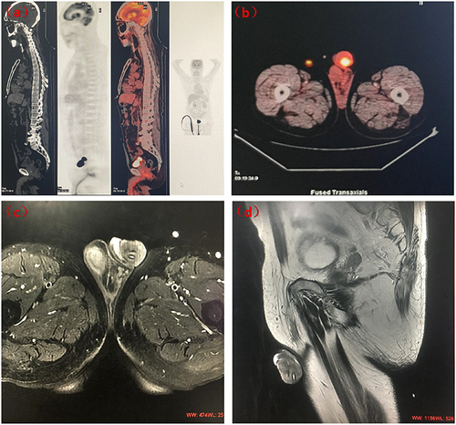 Figure 2 The images before and after chemotherapy. (a and b) Baseline positron emission tomography-computed tomography showing the penile round soft tissue mass with size of about 31*30mm with intense F-18 fluorodeoxyglucose uptake. (c and d): Transaxially and sagittal magnetic resonance imaging revealing the mass of the glans penis about 23×33×26 mm after 3 cycles of chemotherapy.