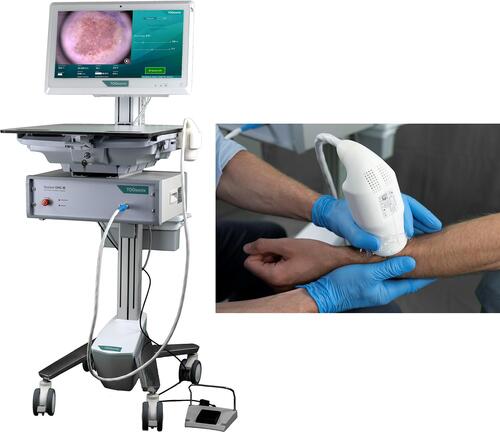 Figure 3 TOOsonix HIFU system operating at 20 MHz. The handpieces have an integrated real-time video camera allowing accurate control and monitoring of the treatment.