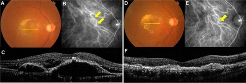 Figure 3 An 80-year-old Japanese man with PCV treated by IVR combined with RF-PDT.