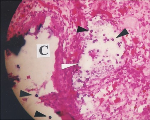 Figure 5 A mature rhinosporidial sporangium without typical walls (white arrow), containing basophilic rhinosporidial endospores (black arrows); the cystic space (C) without a wall represents an atypical sporangium with 2 free endospores (black arrows). Initial magnification × 400. H&E.