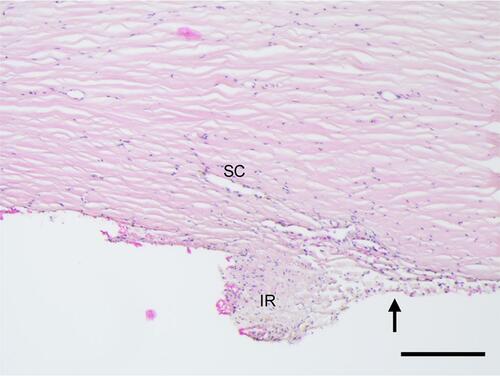Figure 3 Histology of the intact human anterior chamber angle showing the remnant of the iris (IR), the Canal of Schlemm (SC), and the trabecular meshwork (arrow). H&E stained sections, scale bar = 200 µm.