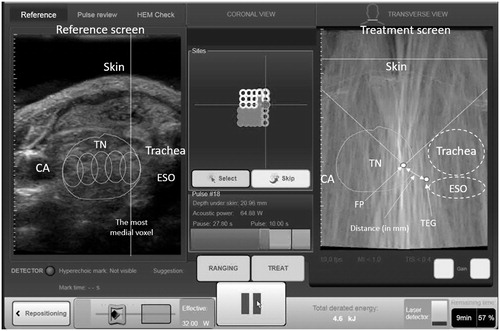 Figure 2. A treatment image captured during the 8-s ablation pulse. FP: focal point of the beams; TEG: tracheoesophageal groove; ESO: oesophagus; TN: thyroid nodule; CA: common carotid artery.