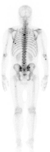 Figure 3 A 99mTc-MDP bone scan revealed bone metastases at the 4th, 5th, 6th, 10th, and 12th thoracic vertebrae and 4th lumbar vertebrae.