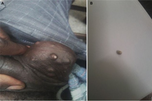 Figure 6 Patient 2: images of idiopathic scrotal calcinosis (A) and 1 extruded calcium stone (B).