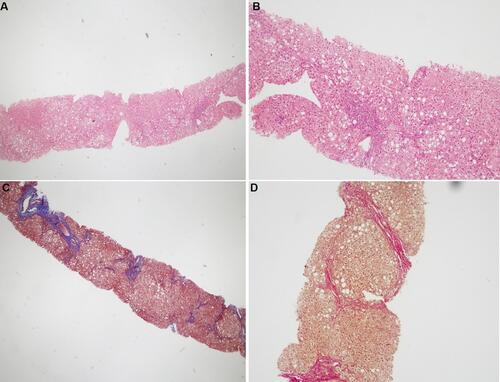 Figure 2 Histopathological findings for patient IV-3 in family F1. (A and B) Hematoxylin and eosin staining shows steatosis, hepatocytes ballooning, and portal lymphocytic infiltration. (C and D) Masson’s trichrome and Van Gieson’s stain, respectfully, showing bridging fibrosis partially forming half nodules. Magnification: 40× (A and C) and 100× (B and D).