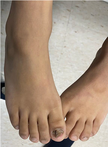 Figure 5 Nail dystrophy of the patient’s right big toe with sparing of the contralateral big toe.
