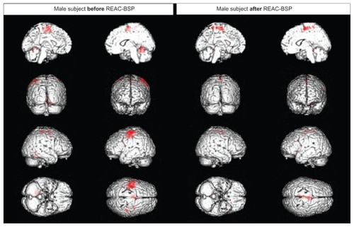 Figure 3 Functional magnetic resonance imaging of a male subject.