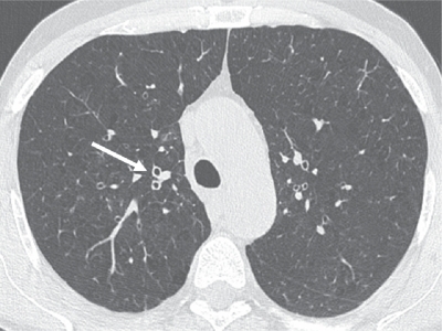 Figure 1 Thin-section CT scan of a smoker with chronic cough associated with chronic obstructive pulmonary disease. The segmental bronchial walls (white arrow) in the upper lobes are thickened. Early centrilobular emphysema is also present.