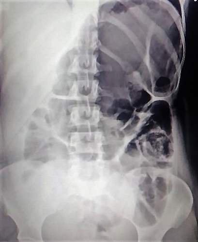 Figure 1 Markedly air filled dilated large bowel extending from right lower quadrant to left upper quadrant, highly suggestive of cecal volvulus.