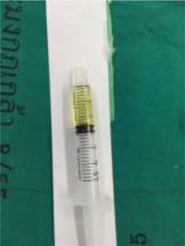 Figure 2 Turbid yellowish vitreous fluid from diagnostic vitrectomy.