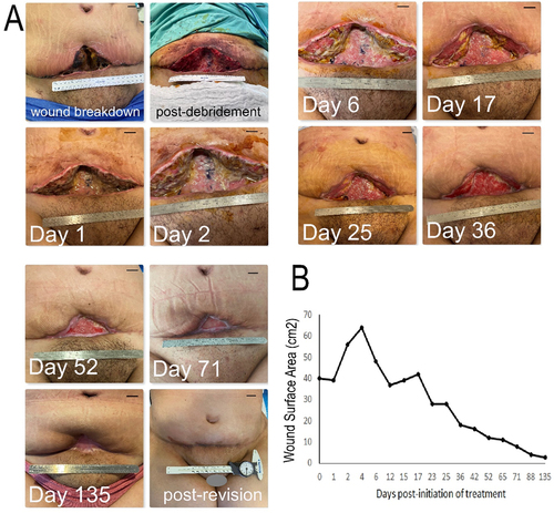 Figure 3. Treatment of a large full-thickness wound in the ventral waistline with topical application of hypoxia preconditioned serum (HPS) obtained from the patient’s peripheral blood. (a) Image panel showing the progression of a wound healing complication in the lower abdomen following an abdominoplasty procedure in a 29-year-old female smoker. Initial wound surface area was 40 cm2. Complete wound closure was achieved at 135 days post-debridement and initiation of treatment with daily application of an emulsion containing 10% HPS. Debridement refers to surgical excision of necrotic tissue deep-down to well-perfused layers. The number of days indicated is counted from the time point of first treatment application. Bars= 1 cm. (b) Plot showing the wound surface area, measured by image analysis, vs. time (days post-initiation of treatment).