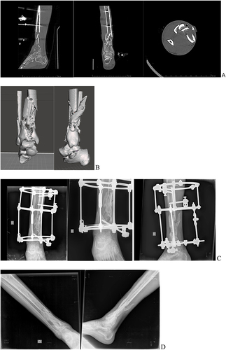 Figure 1 CT images of the distal tibia (A); the 3D anatomical model modeled with CAD software (B); complex tibial plafond fracture treated with circular external fixator (C); outcome of surgical treatment (D).