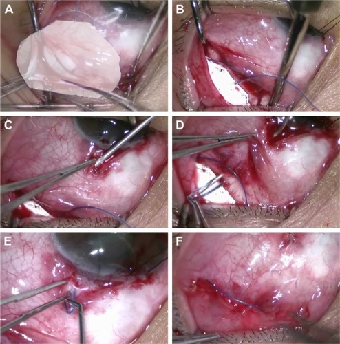 Figure 1 Surgical technique of MT-type glaucoma shunt device (Finetube MT) implantation.
