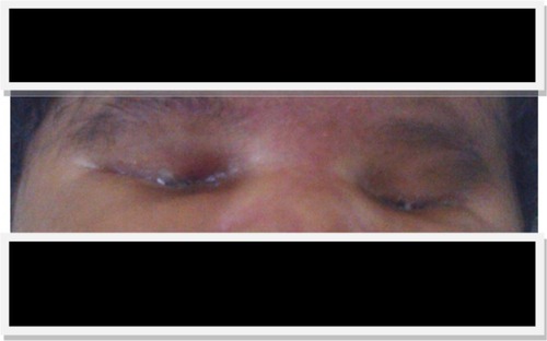 Figure 1 Orbital depression due to orbital cavity emptiness in a newborn with severe right microphthalmia and left anophthalmia.