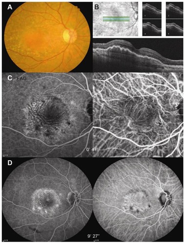 Figure 3 Two months after the macular hole surgery. Darker fluid accumulation is noted in the fundus photograph (A). Optical coherence tomography shows a decrease in height of the pigment epithelial detachment and wrinkling of the pigment epithelial layer (B). Hypofluorescent lines corresponding to the pigment epithelial wrinkles are evident in the angiogram (C and D). Note fine radiating choroidal neovascular network on early phase indocyanine green angiogram (C). Late phase angiogram shows multiple pinpoint leakages and pooling at the lesion (D).