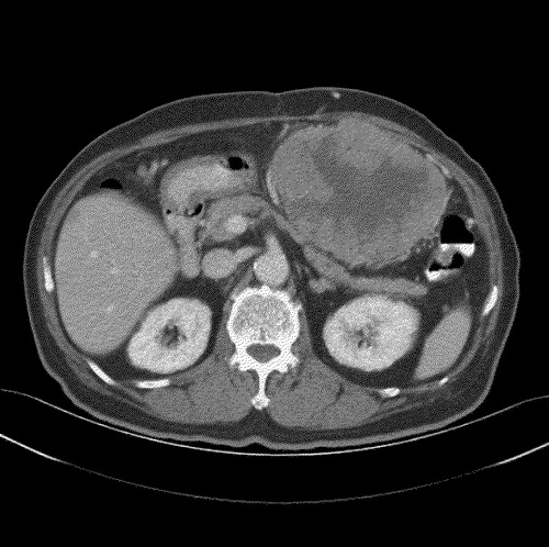 Figure 2.  CT scan in November 2003 showing progressive disease